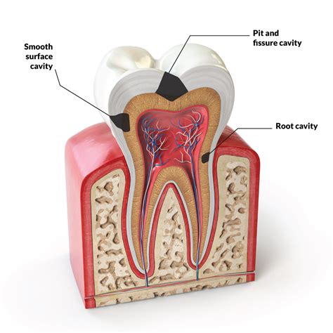 cavity goon|cavity between teeth.